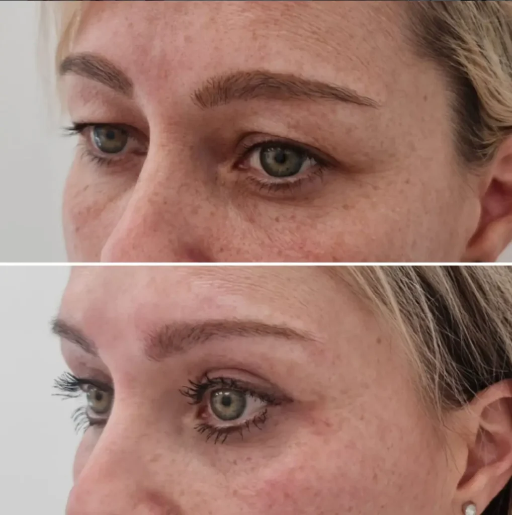 rezultat blefaroplastike prej in potem
